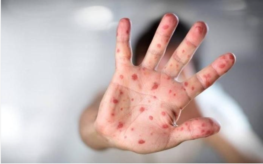 Chăm sóc trẻ bị tay chân miệng tại nhà: 5 việc quan trọng cần làm