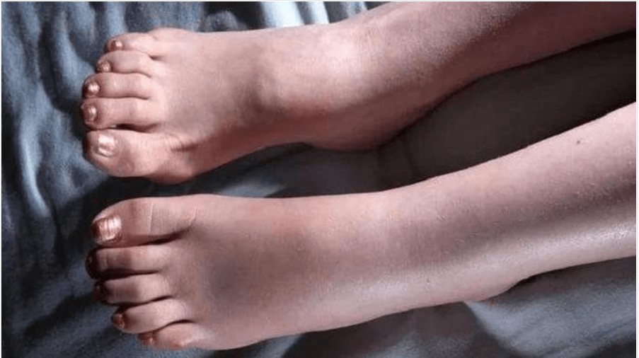 4 dấu hiệu ở chân cảnh báo phổi đang gặp vấn đề nguy hiểm cần phải thăm khám sớm