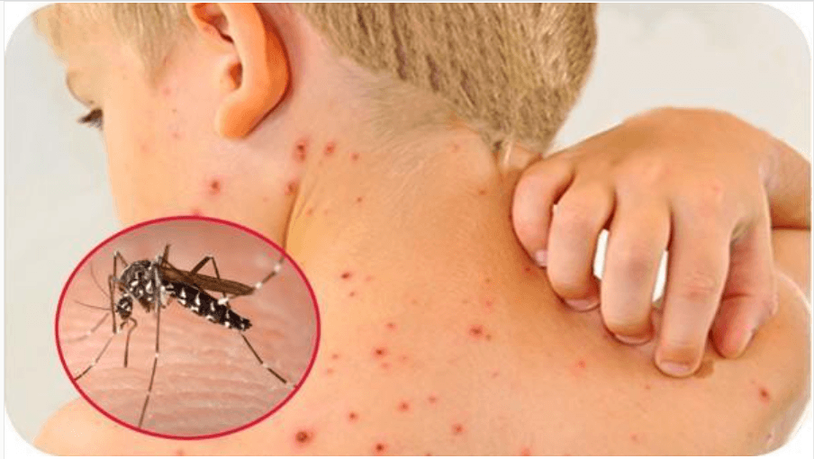 Sốt xuất huyết ở trẻ nhỏ: Triệu chứng và cách điều trị