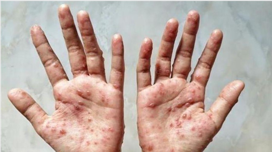 Phân biệt đậu mùa khỉ với thủy đậu, tay chân miệng