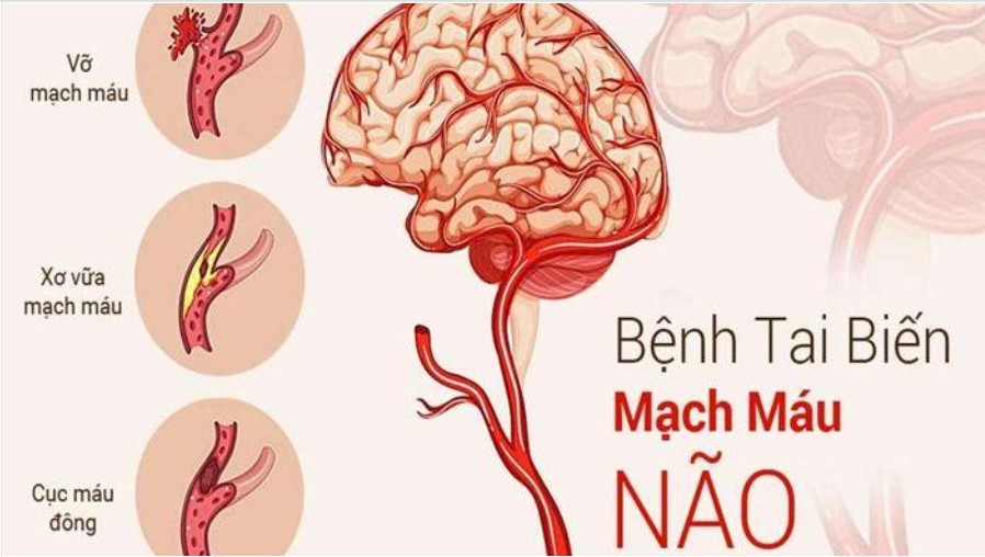 Tai biến mạch máu não – các phương pháp điều trị và dùng thuốc kịp thời để tránh hậu quả nặng nề