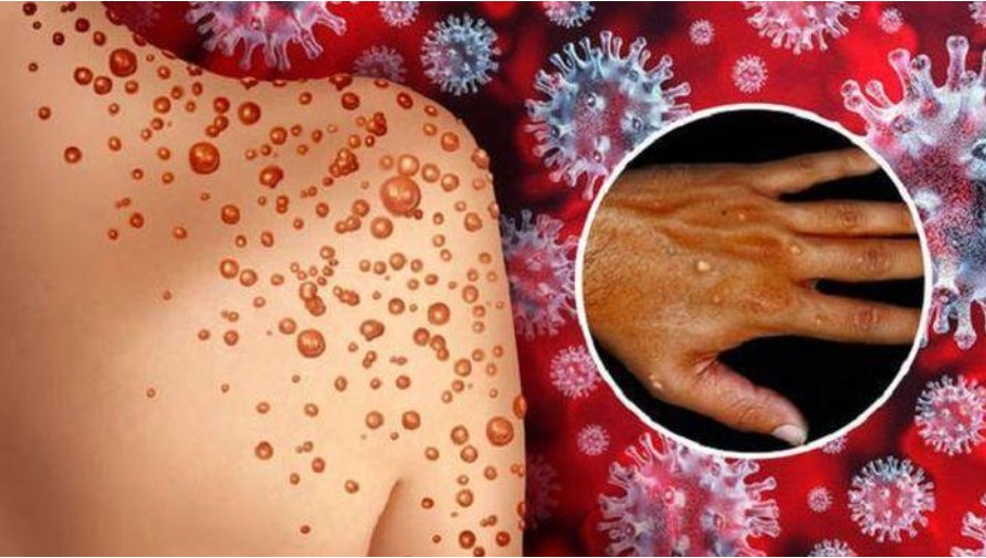 6 khuyến cáo phòng chống bệnh đậu mùa khỉ
