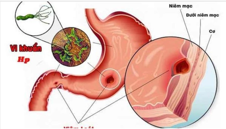 Hiểu đúng về vi khuẩn HP